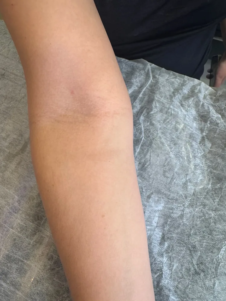 Antebraço após o protocolo completo, pele sem tatuagem