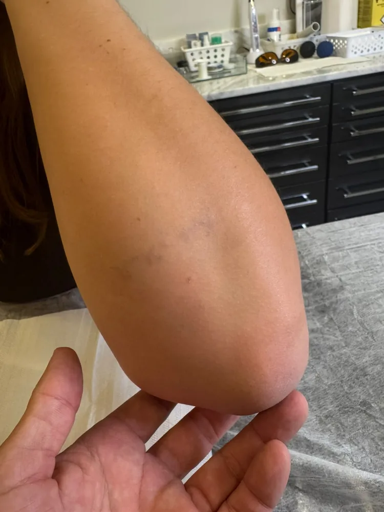 Braço após o protocolo completo, sem tatuagem visível