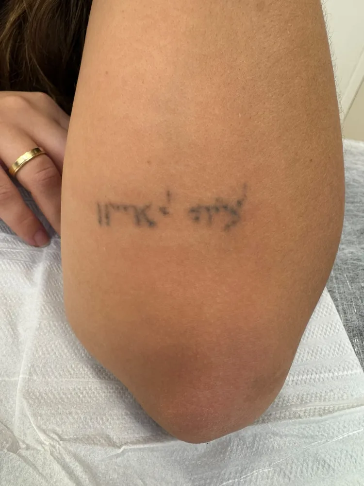 Tatuagem em caracteres hebraicos no braço, antes do tratamento